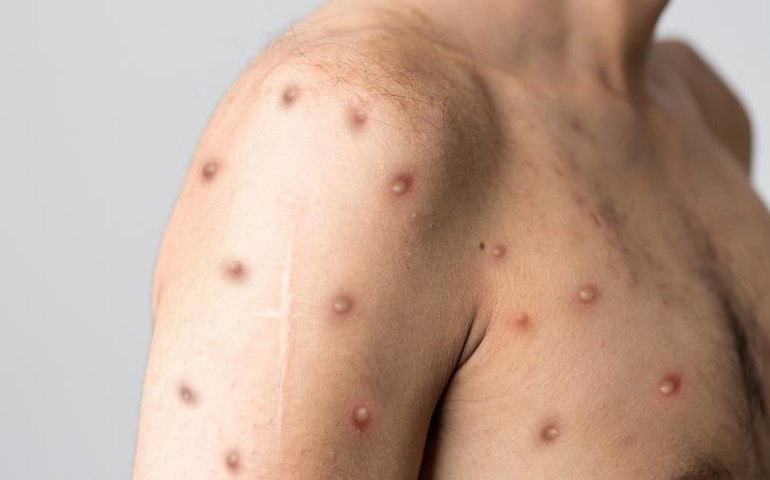 Quatro casos suspeitos de Monkeypox são descartados e Alagoas tem 10 em investigação