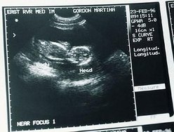 Procedimentos malfeitos podem provocar infecção, perfuração do  útero, do intestino e da bexiga, causando hemorragias, e até a morte