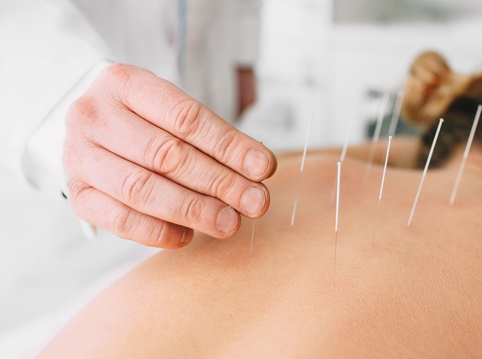HUPAA- Ufal disponibiliza sessões de acupuntura e promove mais qualidade de vida aos colaboradores