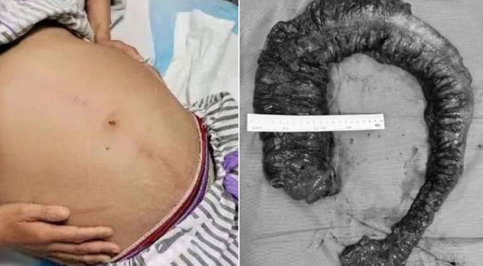 Médicos retiram 20 kg de fezes 'semelhante a píton' do intestino de mulher
