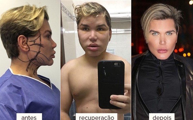 Rodrigo Alves, o Ken Humano, refaz o rosto e admite: ‘Não aceito envelhecer’