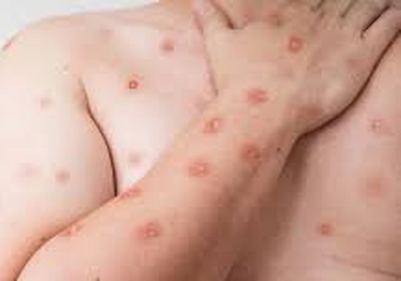 Mpox: Brasil ultrapassa mil casos da doença em 2024