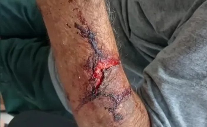 Braço do Idoso de 82 anos  agredido durante roubo de R$ 10 mil em Delmiro Gouveia