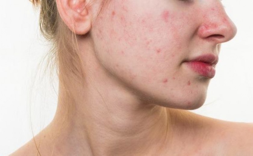 O que fazer em casos de acne? Dermatologista da Sesau explica