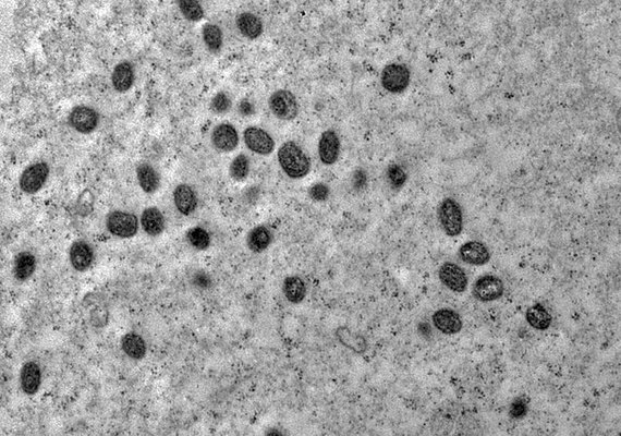 Pesquisa indica risco de monkeypox agravar infeccão por HIV