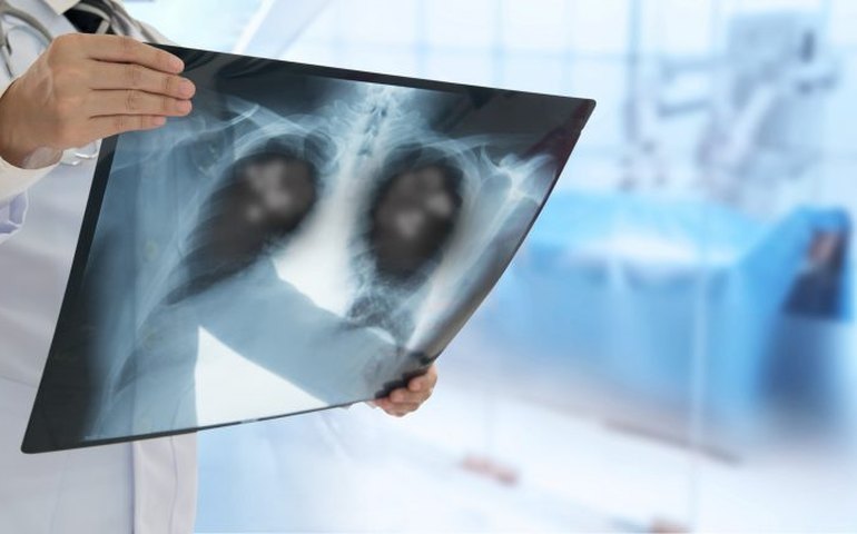 Cancelado debate sobre tratamento do câncer de pulmão no SUS