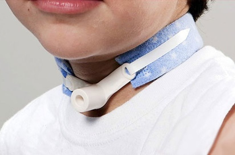 Criança traqueostomizada requer cuidados especiais para viver com saúde e bem-estar