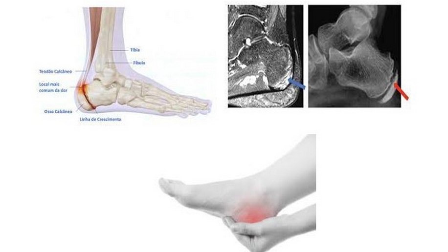 O que é Osteonecrose de Sever?