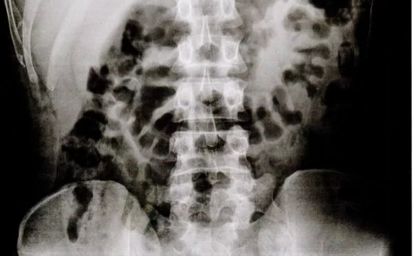 101 presos de SP voltam com objetos escondidos no estômago