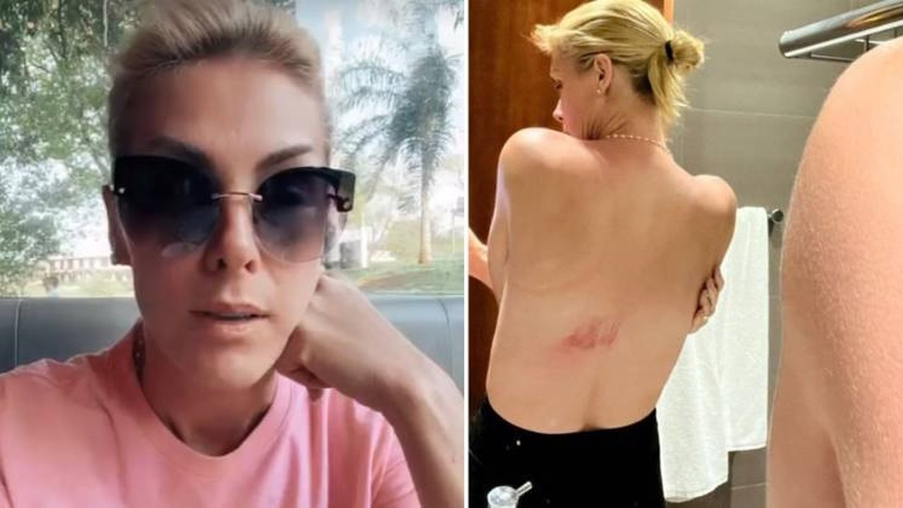 Ana Hickmann cai de cavalo e mostra hematoma: ‘Não quebrei nada mas dor continua’