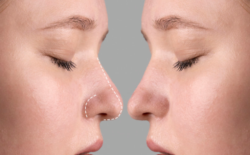 Rinoplastia: estética ou saúde? Entenda quando a cirurgia do nariz é necessária