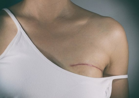 Ministério da Saúde anuncia medidas de combate ao câncer de mama