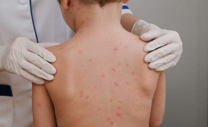 Vacinação é a principal forma de prevenção Vacinação é a principal forma de prevenção