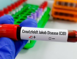 Entenda a Doença de Creutzfeldt-Jakob e a busca por tratamento