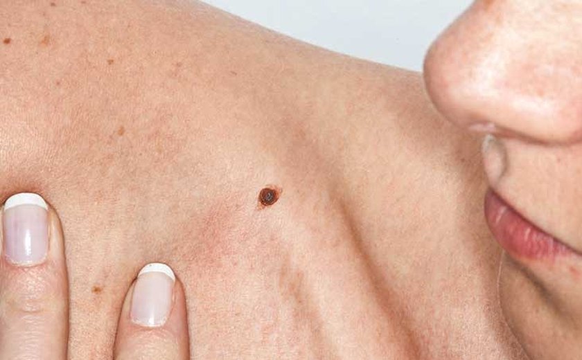 Dezembro Laranja: Especialista alerta sobre os cuidados essenciais para evitar o câncer de pele