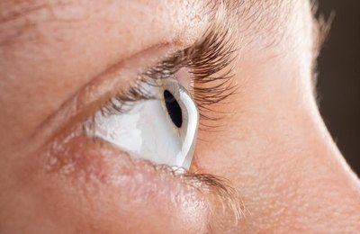 Fatores de risco para o Ceratocone, entre eles coçar os olhos