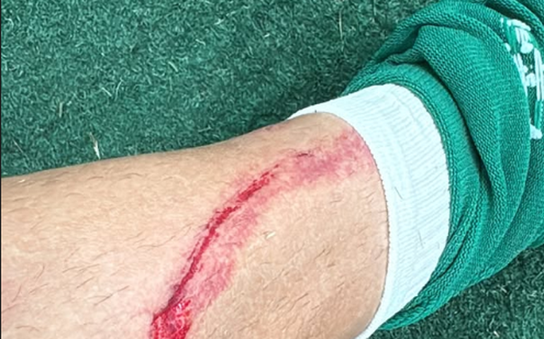 Flaco López posta foto de machucado e Palmeiras vai cobrar FPF por falta de revisão do VAR