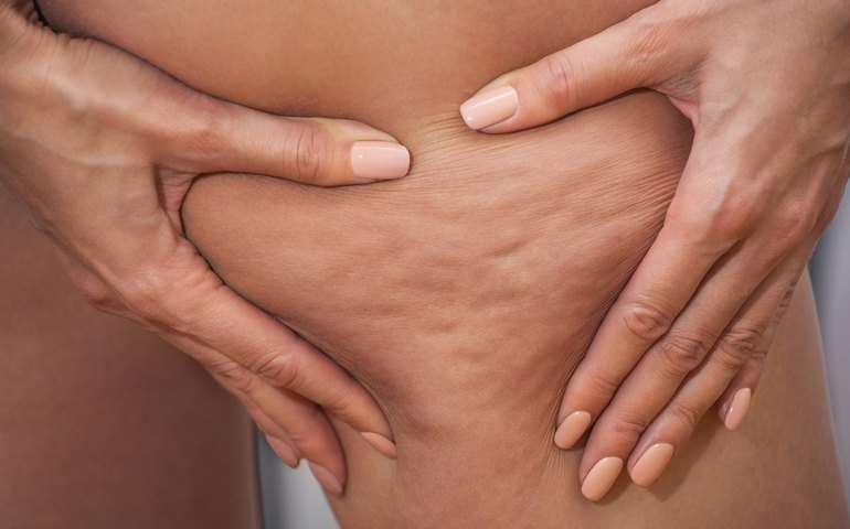 Juliane Massaoka, Amanda Djehdian, Tati Maranhão: veja personalidades que já foram diagnosticadas com lipedema