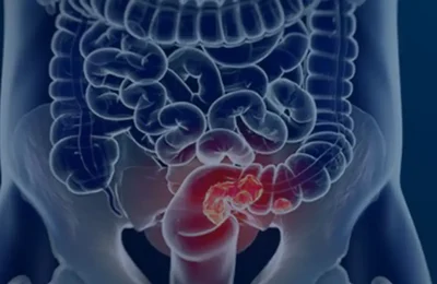 Pacientes com câncer colorretal são diagnosticados em estágio avançado