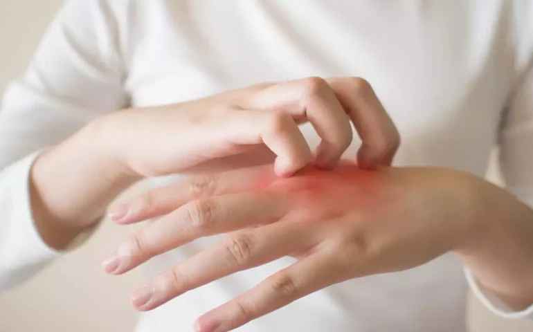 Dedos formigando e coceira nas mãos podem ser sinais de síndrome do túnel do carpo; entenda