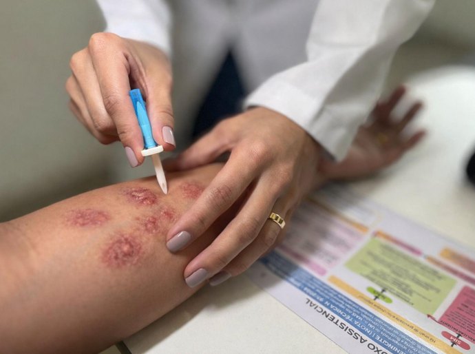 Hospital Ib Gatto Falcão contribui para a detecção precoce e orientação no enfrentamento à hanseníase