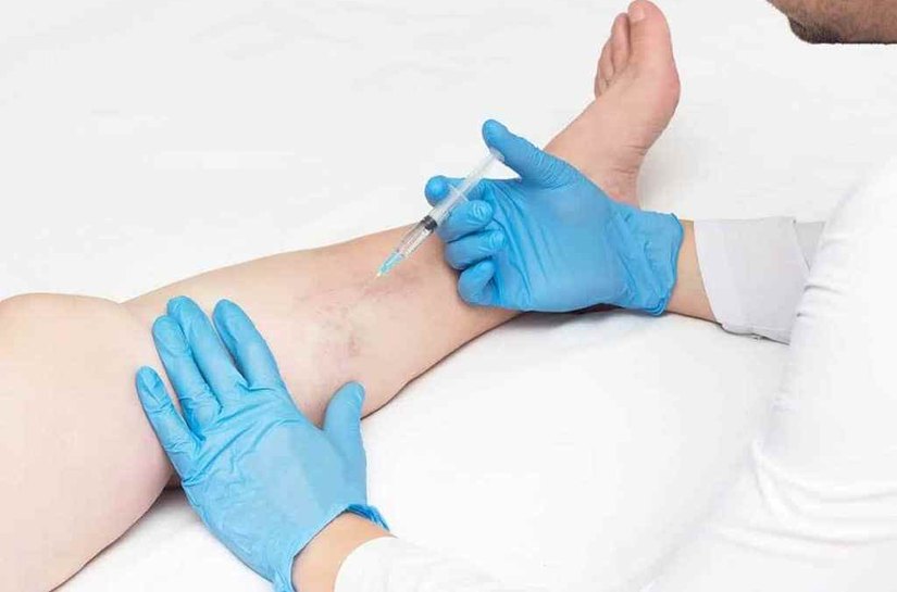 Saúde disponibiliza tratamento de microvasos e varizes no Pam Salgadinho