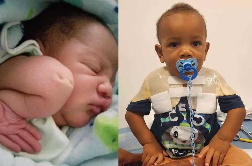 Bebê que nasceu com cotovelo virado para cima surpreende ao evoluir sem cirurgia