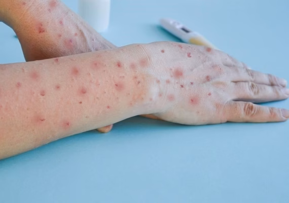 De onde vem a mpox?