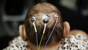 BEBE COM MICROCEFALIA 