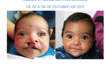 Campanha para correção do lábio leporino quer ampliar ações nos municípios