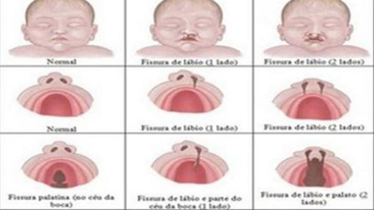 Criança alagoana necessita de cirurgia para reparar lábio leporino e fenda palatina