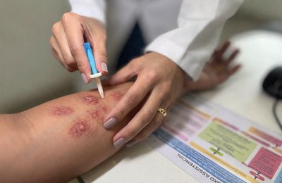 Hospital Ib Gatto Falcão contribui para a detecção precoce e orientação no enfrentamento à hanseníase