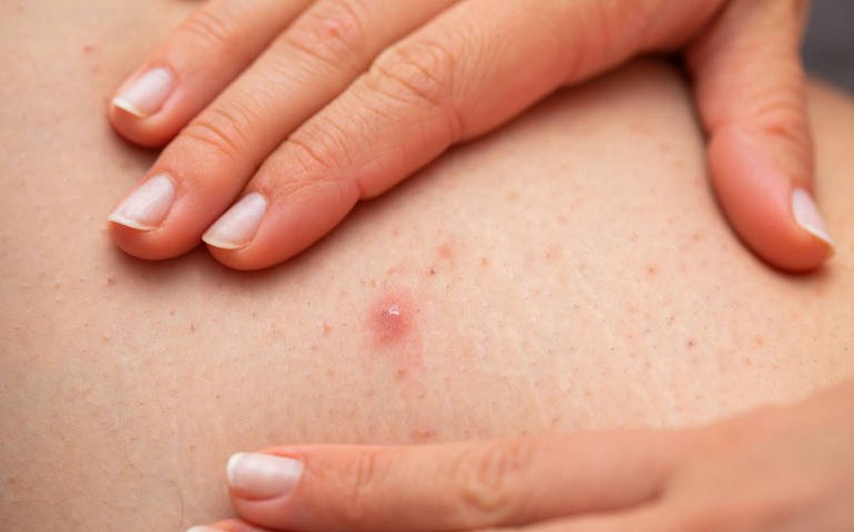 É possível evitar pelos encravados? Dermatologistas explicam