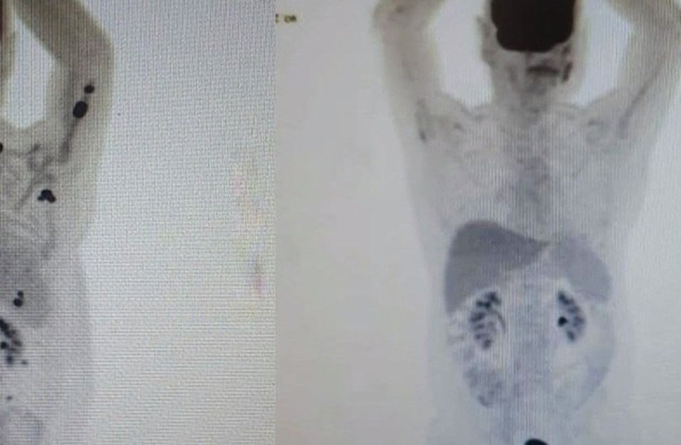 car-t-cancer-30052023110413730 / Foto: Portal R7