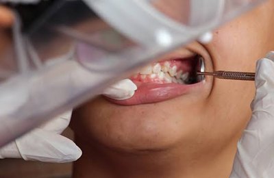 Em parceria com a prefeitura, Projeto SB Brasil promove estudo sobre saúde bucal em bairros de Arapiraca