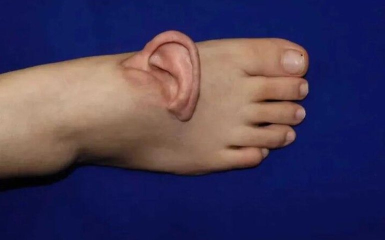 Orelha no pé! Médicos na China realizam cirurgia inédita no mundo