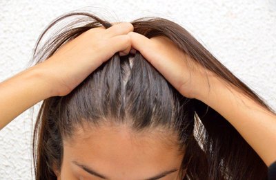 Dermatologista da Sesau explica a diferença entre queda de cabelo e calvície 