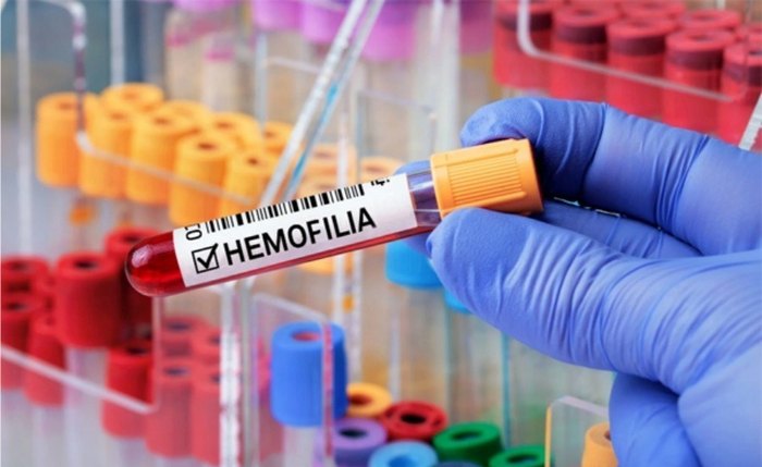 Medicamento  QFITLIA® (fitusirana sódica), da empresa Sanofi Medley, poderá ser usado para prevenir ou reduzir episódios de sangramento