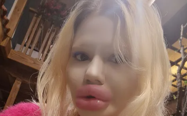 Mulher com maiores lábios do mundo diz que dentistas não querem atendê-la