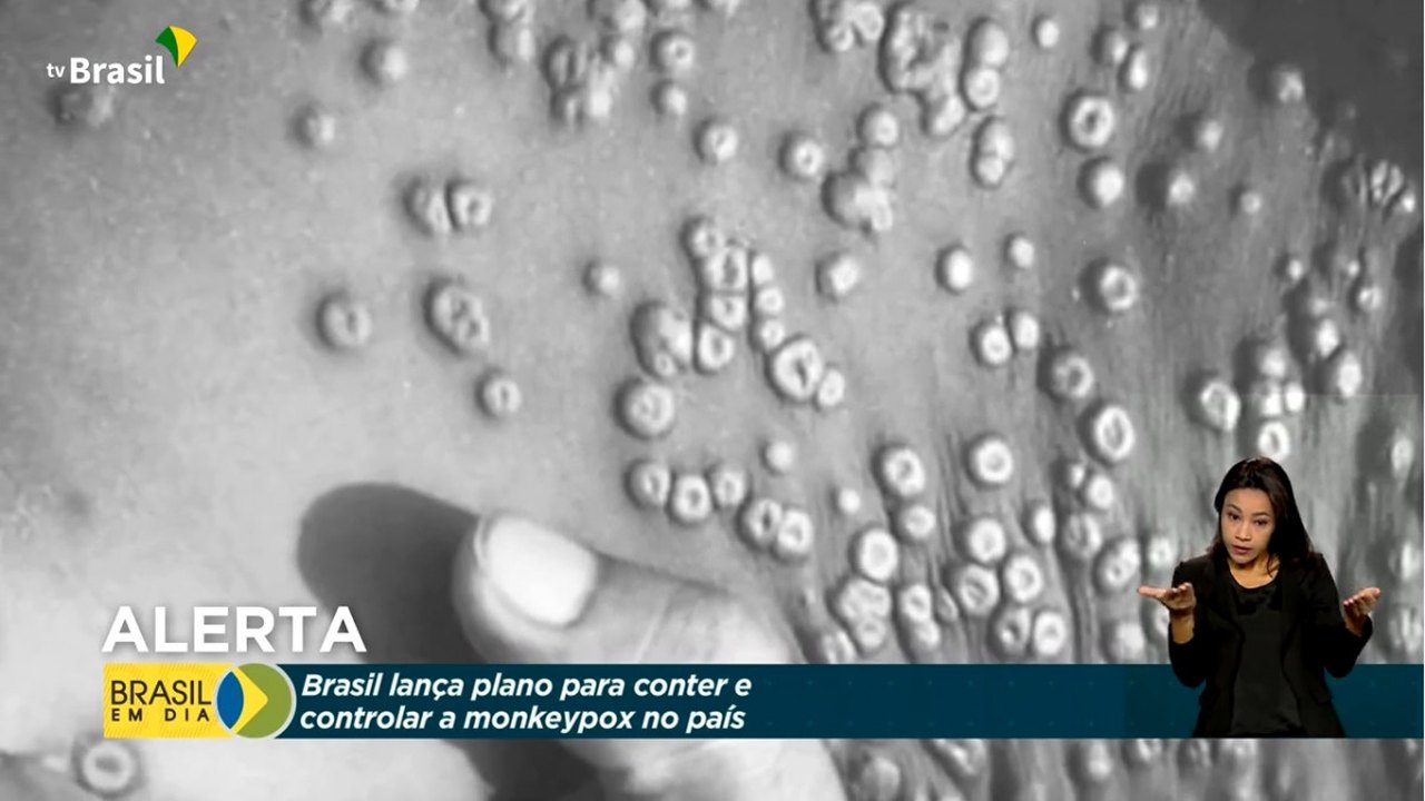 Varíola dos macacos recebe alerta máximo de gravidade no país