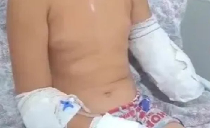 Ramon, de 10 anos, precisou amputar o braço devido a gravidade dos ferimentos