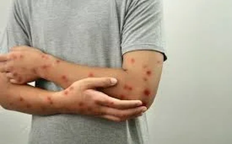 Atenção redobrada diante do aumento de casos de MPOX no Brasil