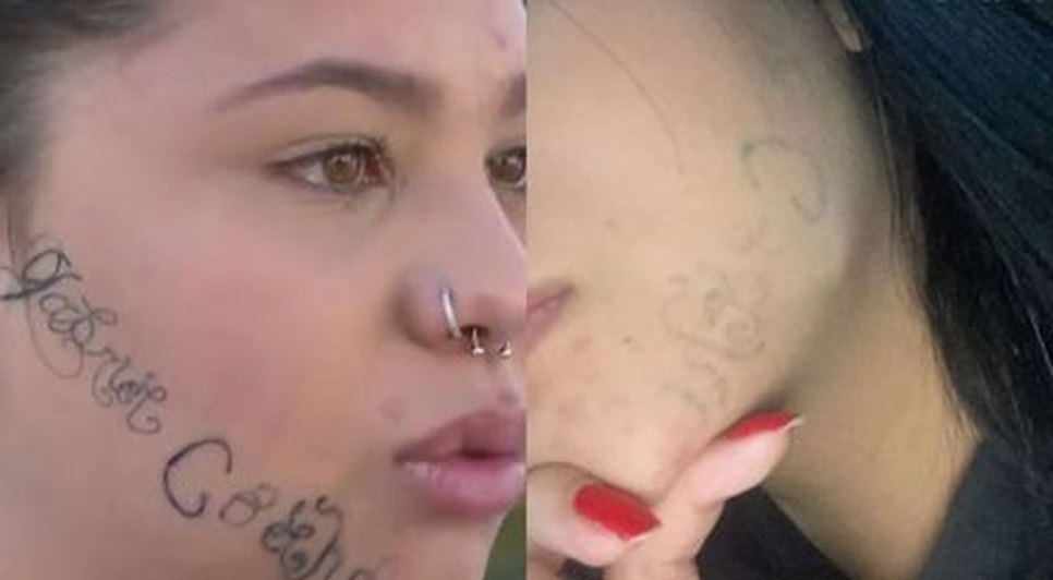 Jovem que teve rosto tatuado à força pelo companheiro mostra antes e depois após sessões de remoção / Foto: Foto: Redes Sociais/ Reprodução