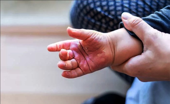 Sete em cada dez acidentes acontecem dentro de casa