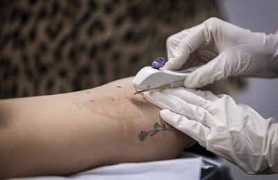 Em dois meses, Implanon é disponibilizado para mais de 600 mulheres