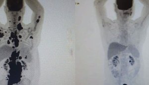 car-t-cancer-30052023110413730 / Foto: Portal R7
