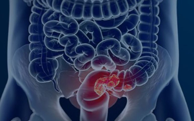 Estudo projeta aumento de 36% em mortes por câncer colorretal até 2040