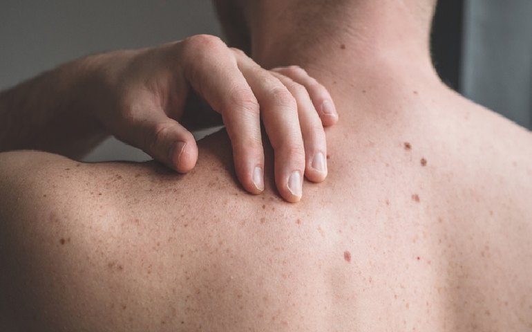 Estudo descobre nova proteína responsável por espalhar câncer de pele