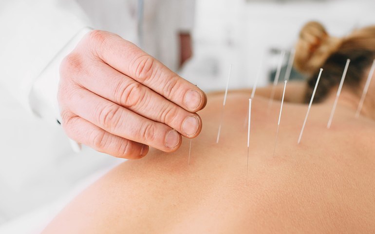 HUPAA- Ufal disponibiliza sessões de acupuntura e promove mais qualidade de vida aos colaboradores