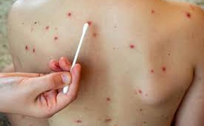 Caso importado de Sarampo no RS desperta preocupações